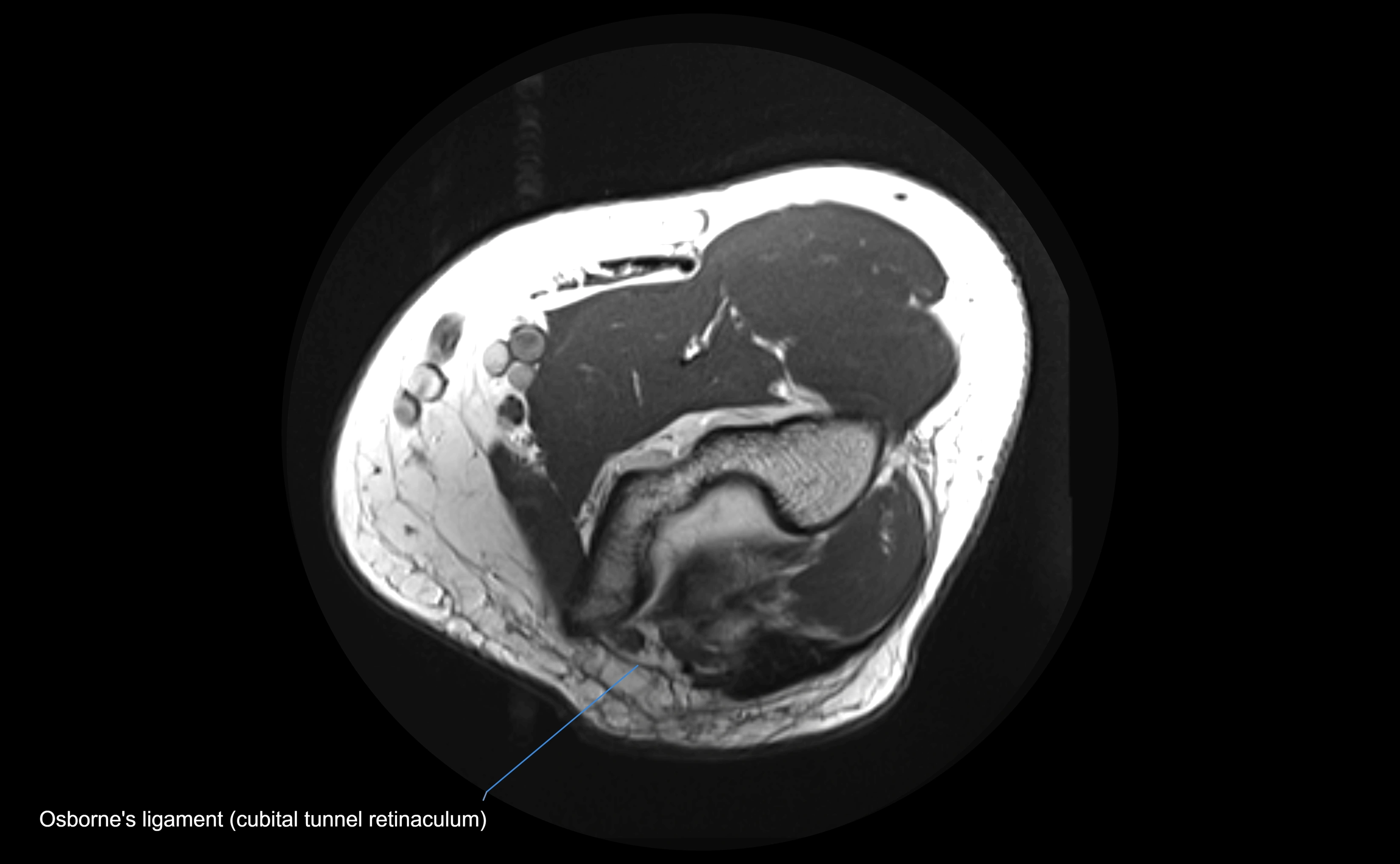 MRI elbow ligaments axial cross sectional anatomy 3T  radiology  image-img-00001-00009.webp